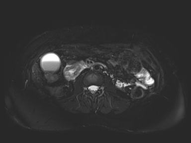 Ampullary adenocarcinoma (Radiopaedia 54765-61014 Axial T2 space-FS 46).jpg