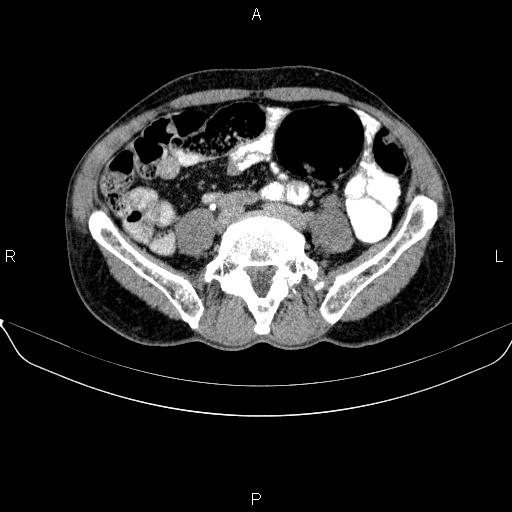 Ampullary adenocarcinoma (Radiopaedia 86093-102032 Axial C+ delayed 72).jpg
