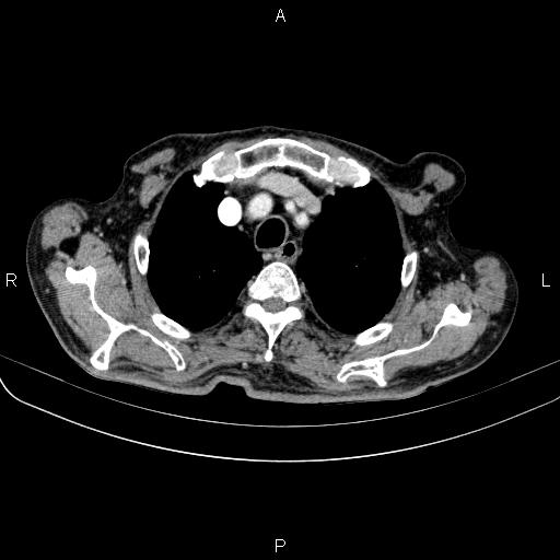 Ampullary adenocarcinoma (Radiopaedia 86093-102033 B 19).jpg
