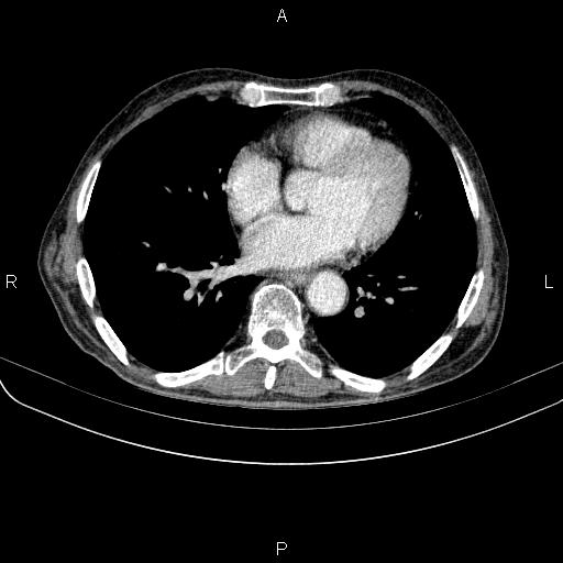 Ampullary adenocarcinoma (Radiopaedia 86093-102033 B 39).jpg