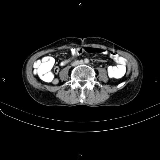 File:Ampullary adenocarcinoma (Radiopaedia 86093-102033 B 81).jpg
