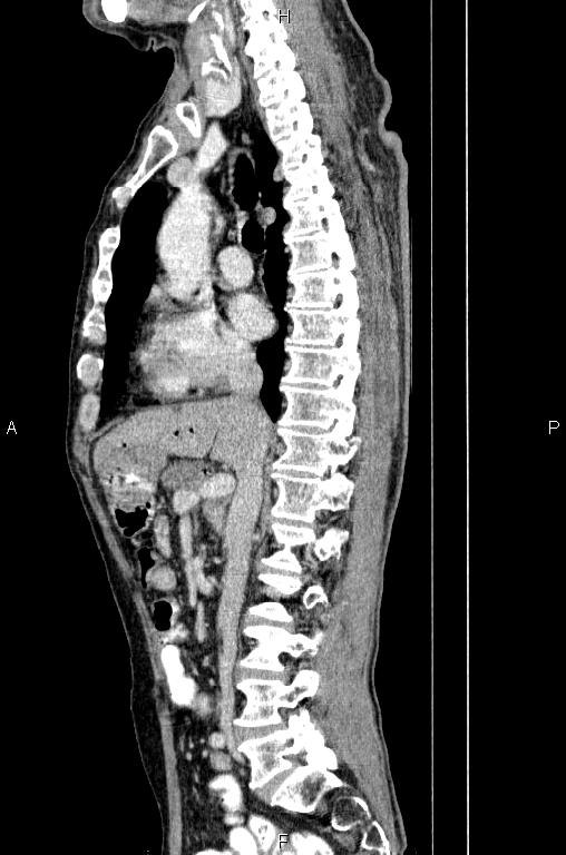 Ampullary adenocarcinoma (Radiopaedia 86093-102033 E 41).jpg