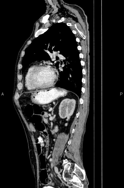 Ampullary adenocarcinoma (Radiopaedia 86093-102033 E 62).jpg