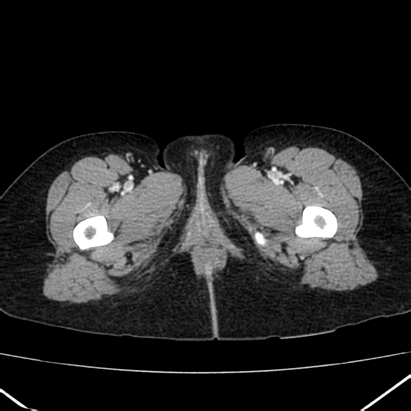 Ampullary tumor (Radiopaedia 22787-22816 C 78).jpg