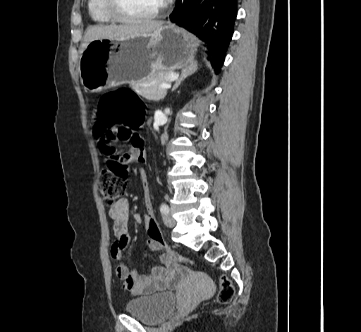 File:Ampullary tumor (Radiopaedia 60333-67998 C 36).jpg
