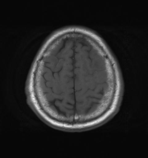 File:Amyloid angiopathy with inflammation (Radiopaedia 30360-31002 Axial T1 28).jpg