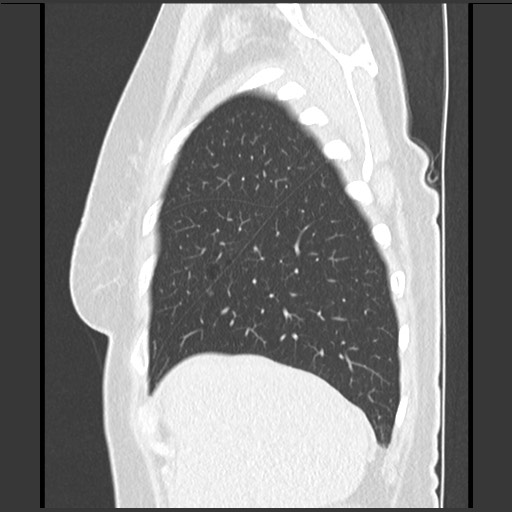 File:Amyloidosis - bronchial and diffuse nodular pulmonary involvement (Radiopaedia 60156-67744 F 10).jpg
