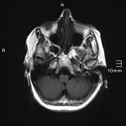 File:Amyotrophic lateral sclerosis (Radiopaedia 70821-81017 Axial T1 6).jpg