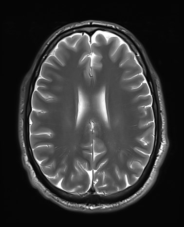 File:Amyotrophic lateral sclerosis (Radiopaedia 87352-103658 Axial T2 19).jpg
