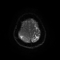 File:Anaplastic astrocytoma (WHO grade III) (Radiopaedia 23559-23664 Axial DWI 39).jpg