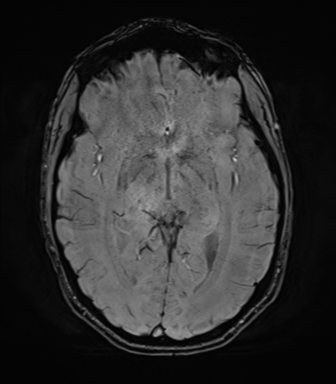 File:Anaplastic astrocytoma IDH mutant (Radiopaedia 50046-55341 Axial SWI 42).png
