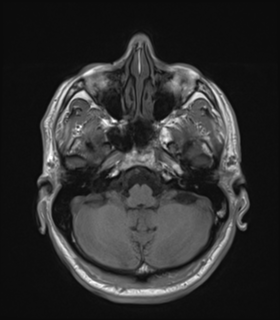 Anaplastic astrocytoma IDH wild-type (Radiopaedia 49984-55273 Axial T1 14).png