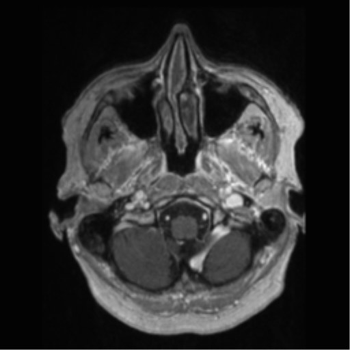 File:Anaplastic astrocytoma IDH wild-type (pseudoprogression) (Radiopaedia 42209-45277 Axial T1 C+ 10).png