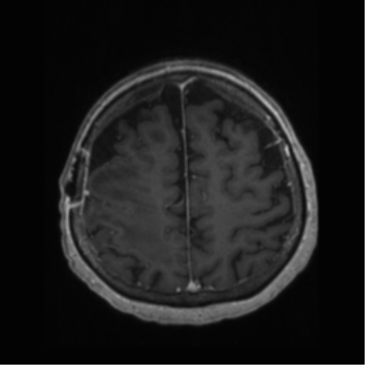 File:Anaplastic astrocytoma IDH wild-type (pseudoprogression) (Radiopaedia 42209-45277 Axial T1 C+ 97).png