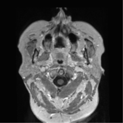 Anaplastic astrocytoma IDH wild-type (pseudoprogression) (Radiopaedia 42209-45278 Axial T1 C+ 10).png