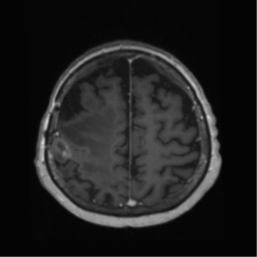 File:Anaplastic astrocytoma IDH wild-type (pseudoprogression) (Radiopaedia 42209-45278 Axial T1 C+ 117).png