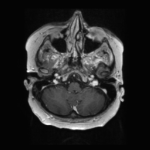 File:Anaplastic astrocytoma IDH wild-type (pseudoprogression) (Radiopaedia 42209-45279 Axial T1 C+ 29).png