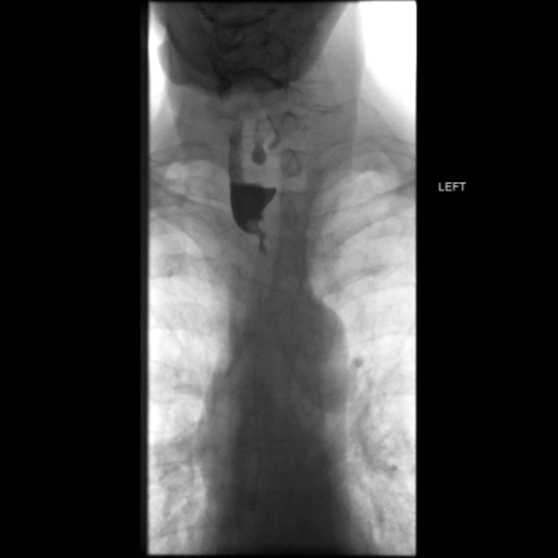 File:Anastomotic stricture post Ivor Lewis esophagectomy (Radiopaedia 47937-52715 Frontal 9).png