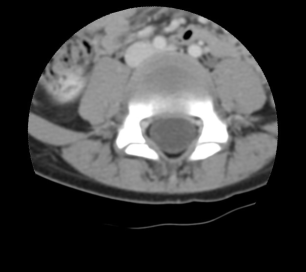 Aneurysmal bone cyst - sacrum (Radiopaedia 65190-74195 Axial non-contrast 6).jpg