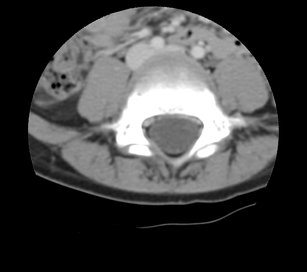 Aneurysmal bone cyst - sacrum (Radiopaedia 65190-74195 Axial non-contrast 7).jpg