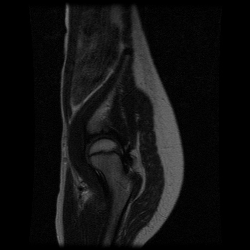 File:Aneurysmal bone cyst - sacrum (Radiopaedia 65190-74196 Sagittal T2 4).jpg