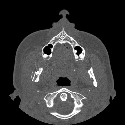 Aneurysmal bone cyst of the mandible (Radiopaedia 43280-46823 Axial bone window 96).jpg