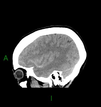File:Aneurysmal subarachnoid hemorrhage with intra-axial extension (Radiopaedia 84371-99699 B 37).jpg