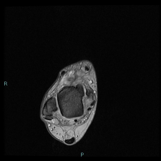 Ankle ganglion cyst (Radiopaedia 62809-71162 Axial Gradient Echo 58).jpg