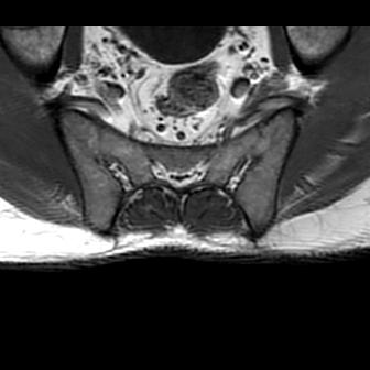File:Ankylosing spondylitis with zygapophyseal arthritis (Radiopaedia 38433-40517 B 10).jpg