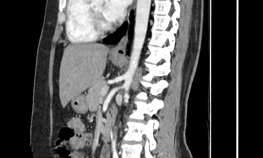 Annular pancreas (Radiopaedia 70359-80453 B 34).jpg
