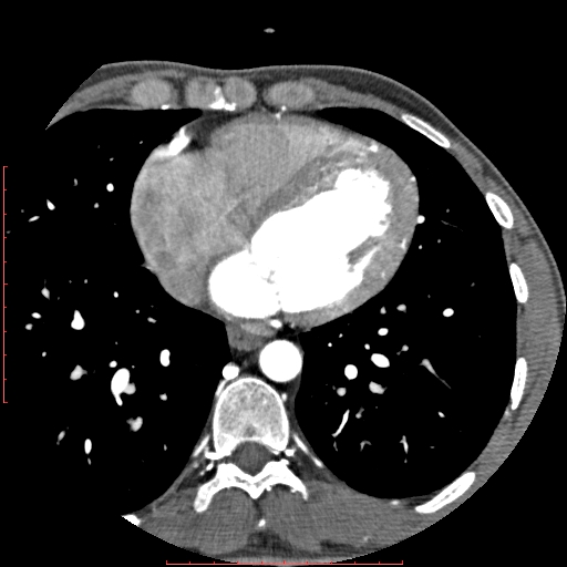 File:Anomalous left coronary artery from the pulmonary artery (ALCAPA) (Radiopaedia 70148-80181 A 228).jpg