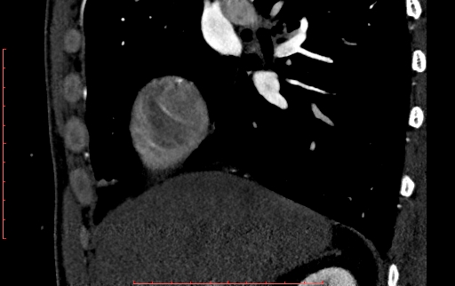 Anomalous left coronary artery from the pulmonary artery (ALCAPA) (Radiopaedia 70148-80181 C 12).jpg