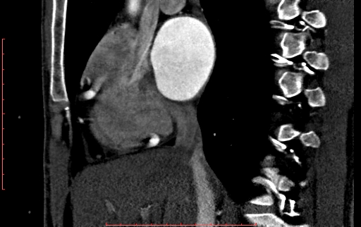 File:Anomalous left coronary artery from the pulmonary artery (ALCAPA) (Radiopaedia 70148-80181 C 65).jpg