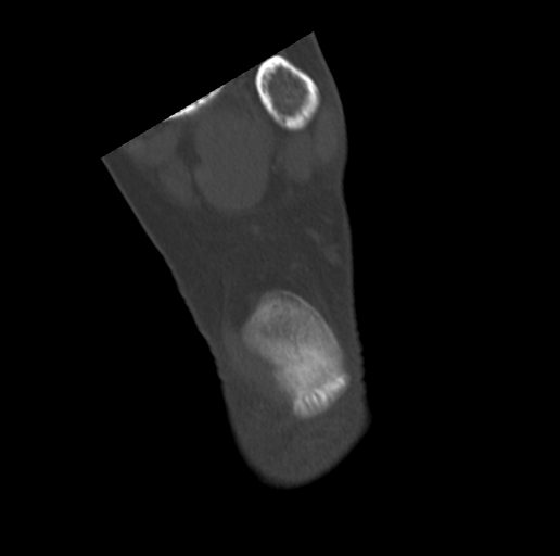 Anterior calcaneal process fracture (Radiopaedia 47384-51989 Coronal bone window 73).png