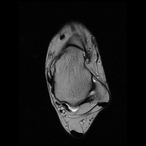 File:Anterior calcaneal process fracture (Radiopaedia 74654-85611 Axial T2 11).jpg