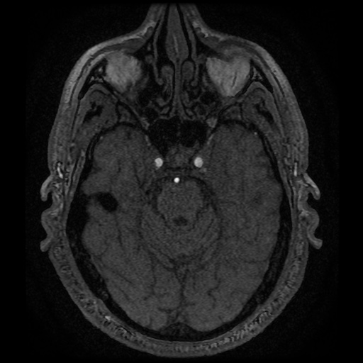 Anterior cerebral artery infarction (Radiopaedia 46794-51323 Axial MRA 48).jpg