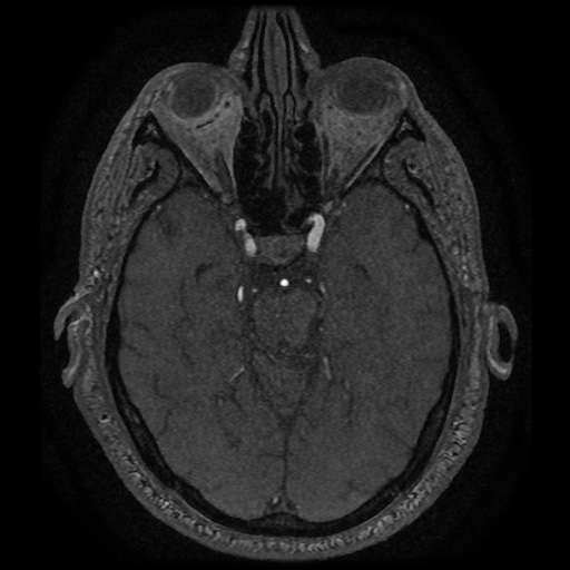 Anterior cerebral artery infarction (Radiopaedia 46794-51323 Axial MRA 65).jpg