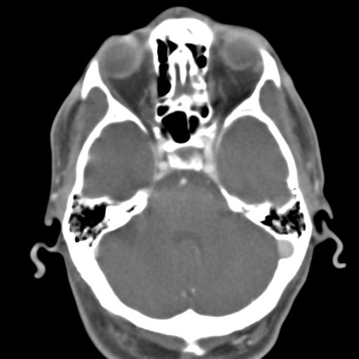 File:Anterior cerebral artery territory infarct (Radiopaedia 39327-41581 B 41).png