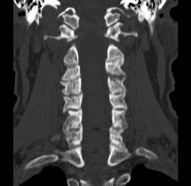 Anterior cervical postdiscectomy arthrodesis (Radiopaedia 32678-33646 Coronal bone window 35).jpg