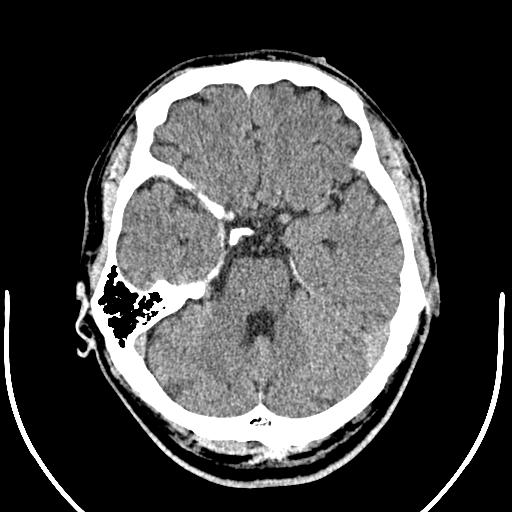 Anterior choroidal artery infarct (Radiopaedia 55106-61480 Axial non-contrast 16).jpg