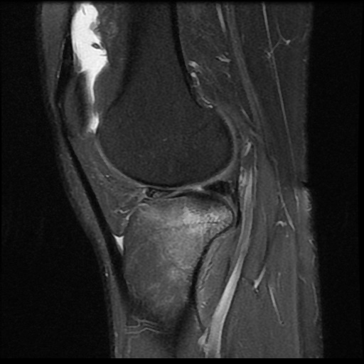File:Anterior cruciate ligament avulsion fracture (Radiopaedia 58939-66193 Sagittal PD fat sat 8).jpg