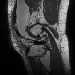Anterior cruciate ligament rupture with Segond fracture (Radiopaedia 69043-78806 Sagittal PD 152).jpg