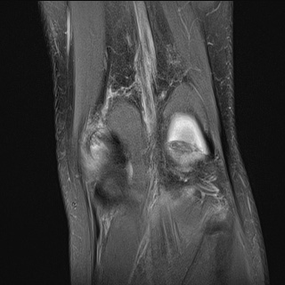 File:Anterior cruciate ligament tear - pediatric (Radiopaedia 62152-70260 Coronal PD fat sat 4).jpg