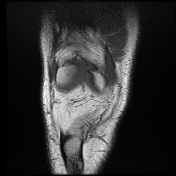 File:Anterior cruciate ligament tear with posteromedial corner injury, bucket-handle meniscal tear and chondral delamination (Radiopaedia 75501-86744 Coronal T1 6).jpg