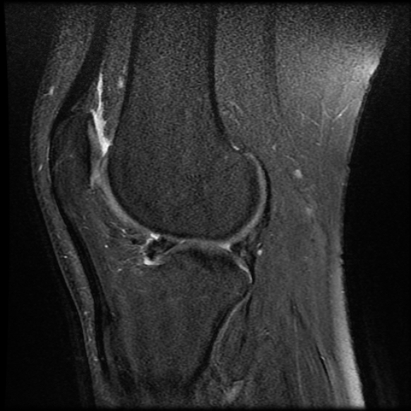File:Anterior cruciate ligament tear with posteromedial corner injury, bucket-handle meniscal tear and chondral delamination (Radiopaedia 75501-86744 Sagittal PD fat sat 18).jpg