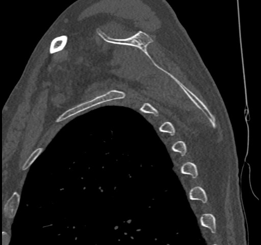 Anterior glenohumeral dislocation with Hill-Sachs lesion (Radiopaedia 62877-71249 Sagittal bone window 51).jpg