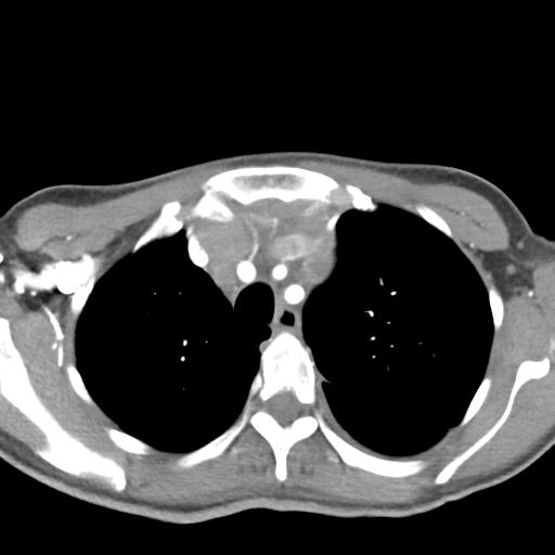 Anterior mediastinal lymphoma (Radiopaedia 29556-30061 C 13).jpg