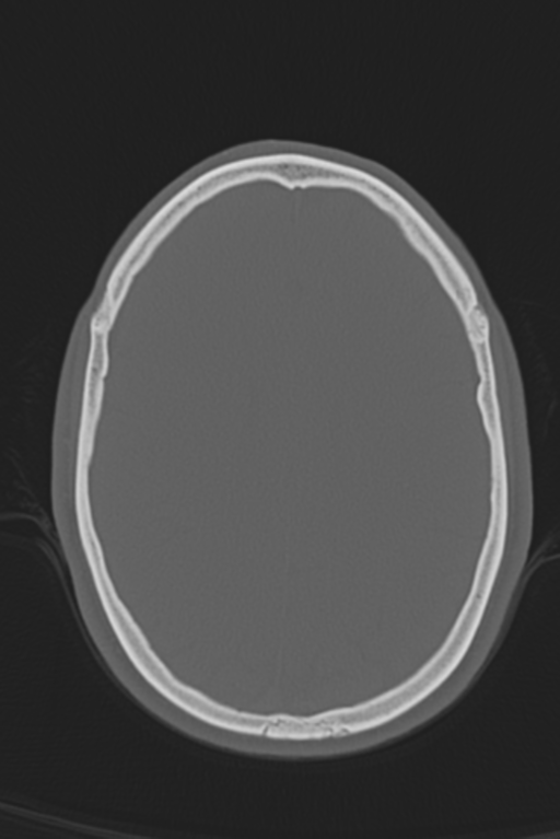 Anterior nasal spine fracture (Radiopaedia 46138-50494 Axial bone window 22).png