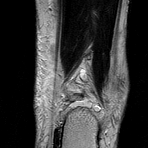 File:Anterior talofibular ligament rupture (Radiopaedia 15831-15484 Coronal T2 19).jpg
