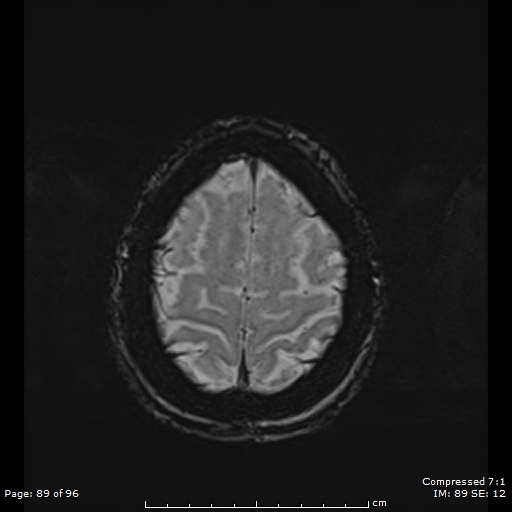 Anterior temporal lobe perivascular space (Radiopaedia 88283-104914 Axial SWI 58).jpg